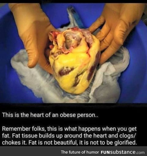 Fat acceptance kills, end of story