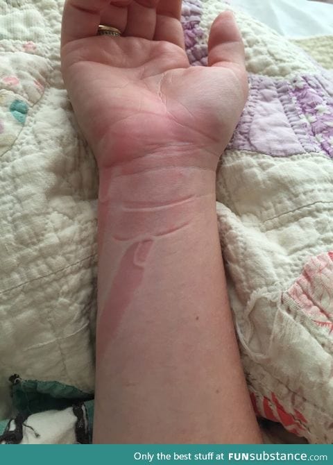 I slept on my finger and it left a perfect indention on my arm