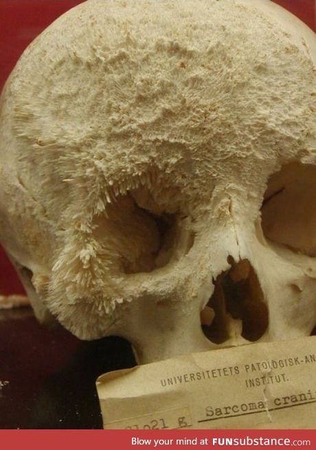 Bone Cancer patient's bone