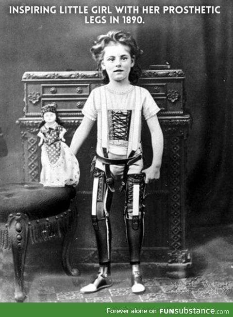 History Photo Day 14: early prosthetics