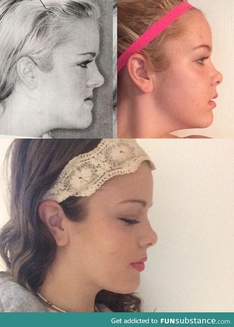 "One year ago today, I shared the top photo as results from a jaw surgery."
