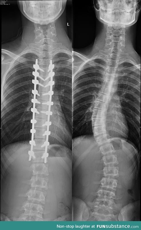 Scoliosis surgery before and after x-rays