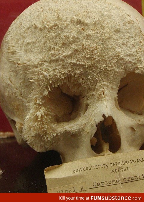 Bone Cancer