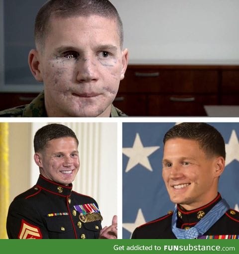 Medal Of Honor recipient Kyle Carpenter before and after facial reconstruction surgery