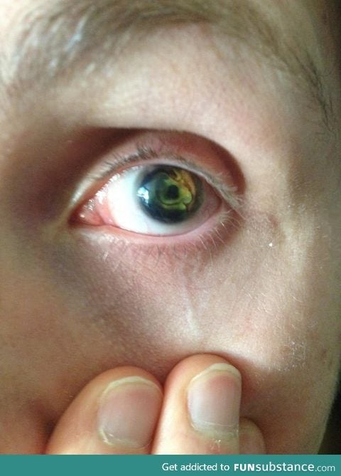 I think my blind friends eye is amazing!