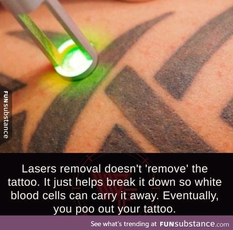 How laser tattoo removal works