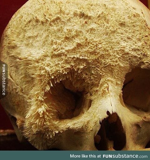 Bone cancer