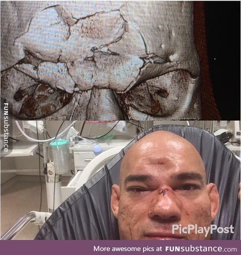 Picture of Cyborg Santos' skull - the MMA fighter that got took a knee to the head