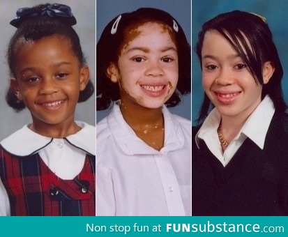 The effects of Vitiligo on a school girl