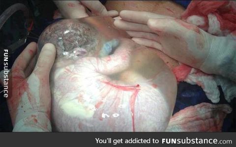 Born with Amniotic Sac intact