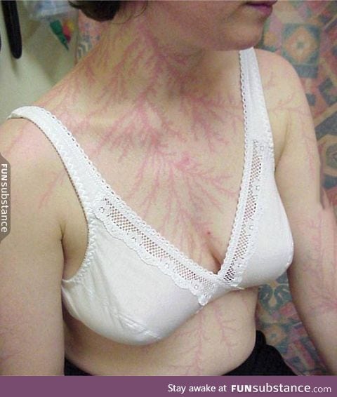 Woman with Lichtenberg figures, lightning-shaped scars from being hit by lightning