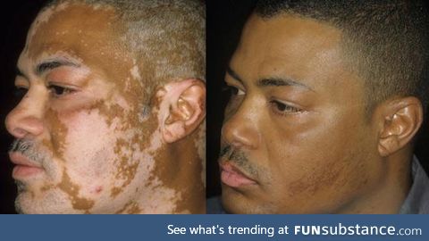 Tattooing to cover up vitiligo