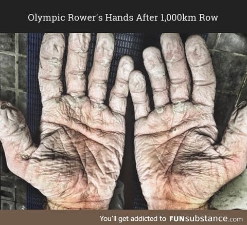 Olympic Rower's Hands After 1,000km Row