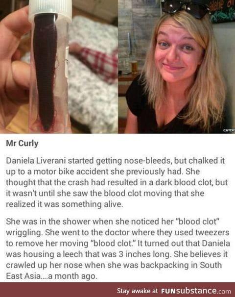 Daniela discovered her blood clot was actually a monster