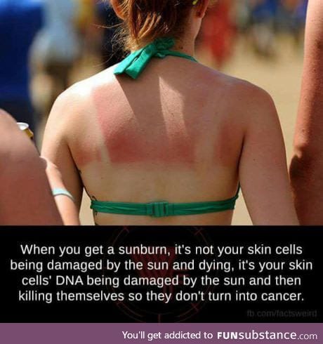 What is sunburn