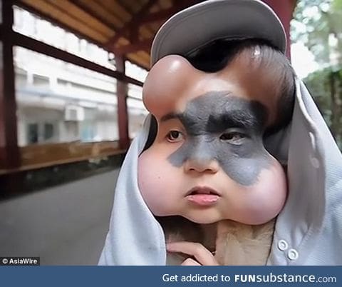 Woman has balloons implanted in her face to expand the skin around a dangerous birthmark