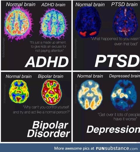 ADHD, PTSD, Bipolar and Depression