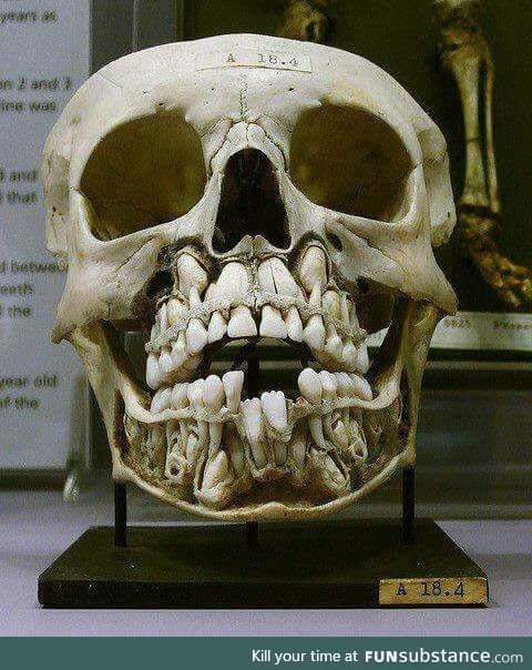 A child's skull before losing baby teeth
