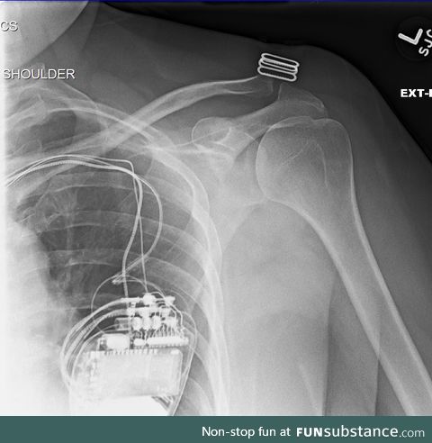 X-ray of shoulder that shows pacemaker