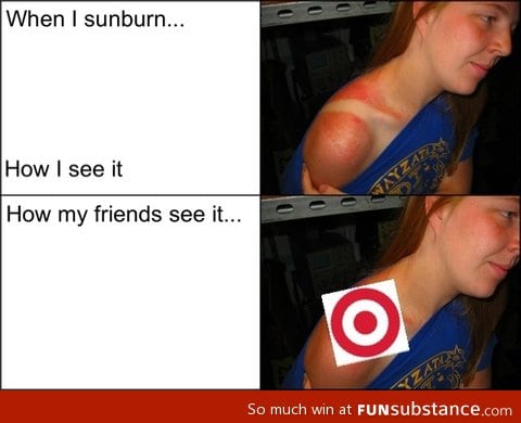 Whenever I get sunburned