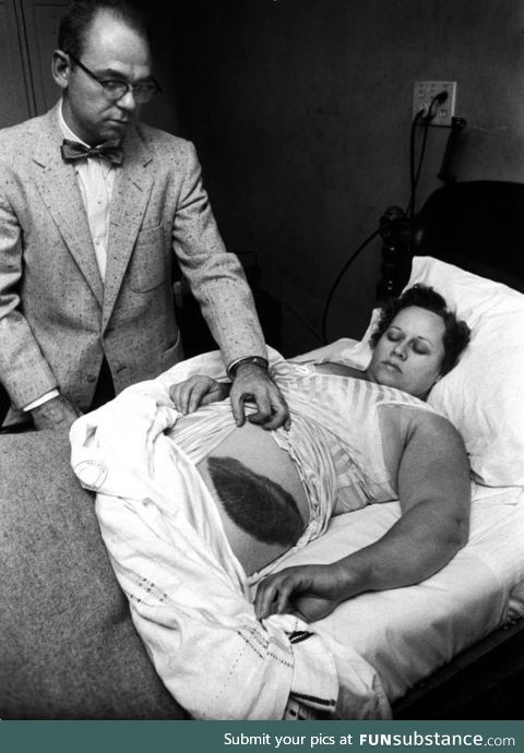 Ann Hodges, the only confirmed person in history to have been hit by a meteorite