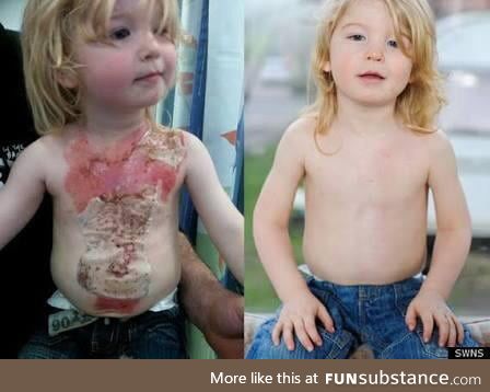 Two year old with second degree burns treated with stem cell therapy for amazing results
