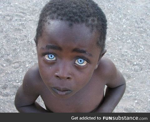 Boy with ocular albinism