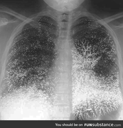 X-ray of a patient who attempted suicide by injecting themselves with mercury