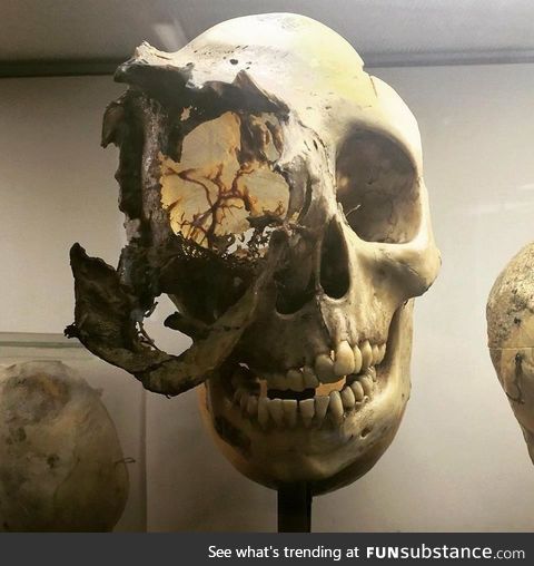 A skull with rare bone cancer (Chordoma)