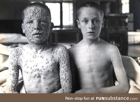 Photo of two children - one vaccinated against smallpox, the other not