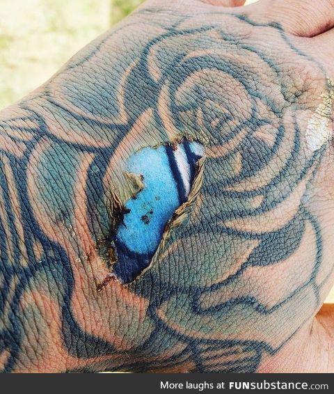 ‌Epidermal burn of the hand exposes bright colors of tattoo ink embedded in the dermal