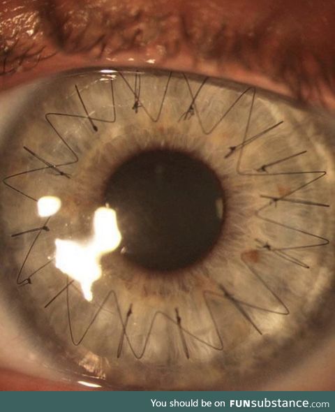 Close up image showing the stitches in the eye after a cornea transplant