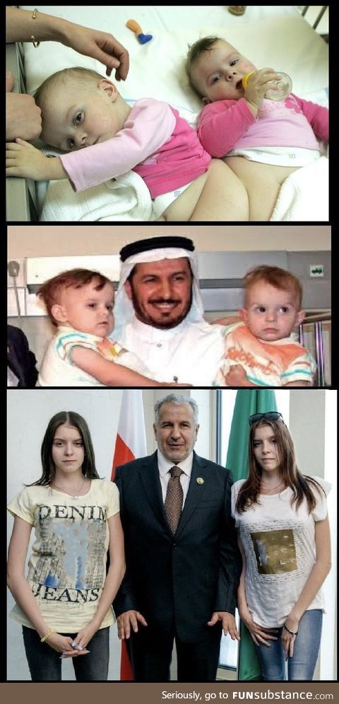 In 2005 "Olga and Daria" conjoined twins from Poland went to Saudi Arabia to