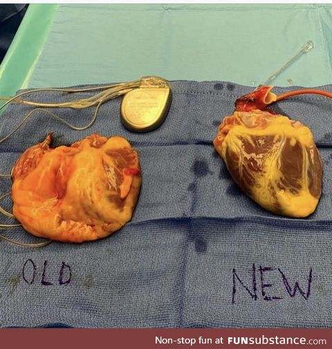 Heart transplant: A bad heart going out and a new heart going in