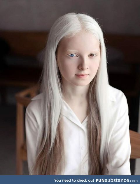 Girl with Albinism and Heterochromia
