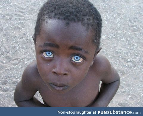Boy with ocular albinism