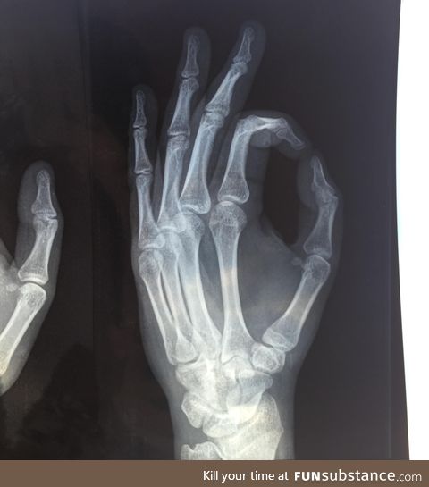 My friend fractured his thumb, then sent me this... He got me good