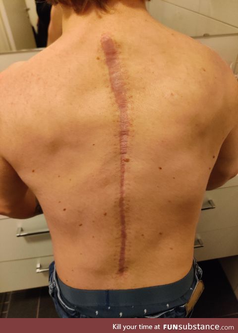 Me after four months of recovery from scoliosis surgery (I had 70°)