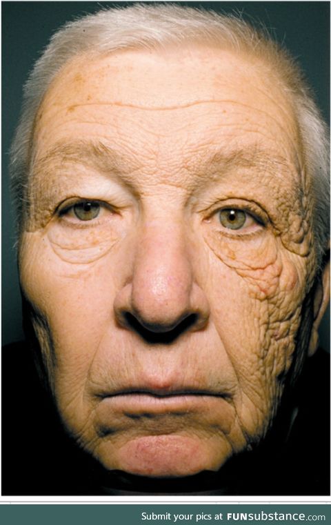 A trucker's skin damage on left side of his face after 28 years on the road