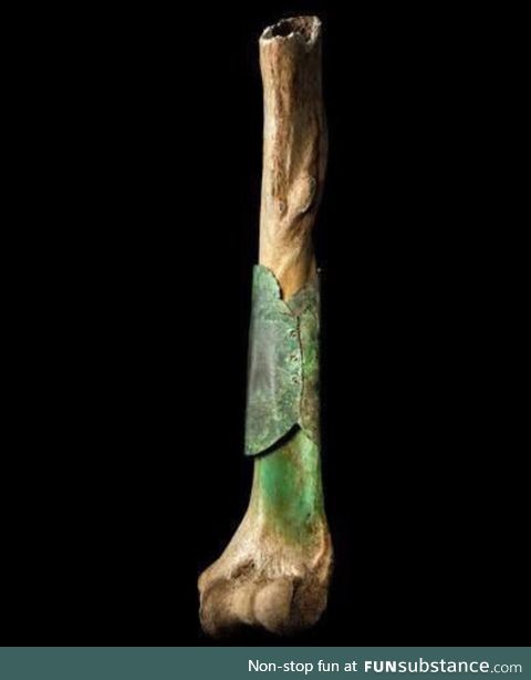 A medieval surgeon repaired bone with riveted copper