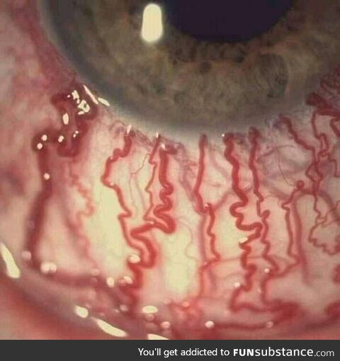 Human eye after crying