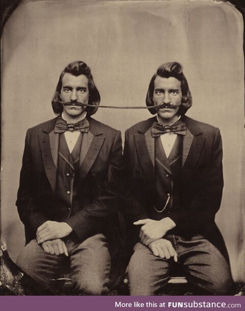 Siamese twins. 1903. At that time, such complex surgery to separate them did not yet