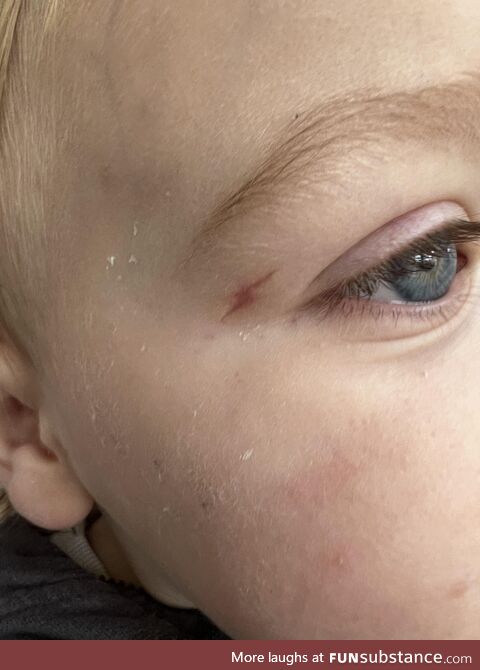 My sons lightning bolt scar