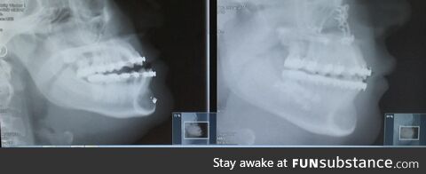 Got jaw surgery, my skull has transformed from chimpanzee to human ????