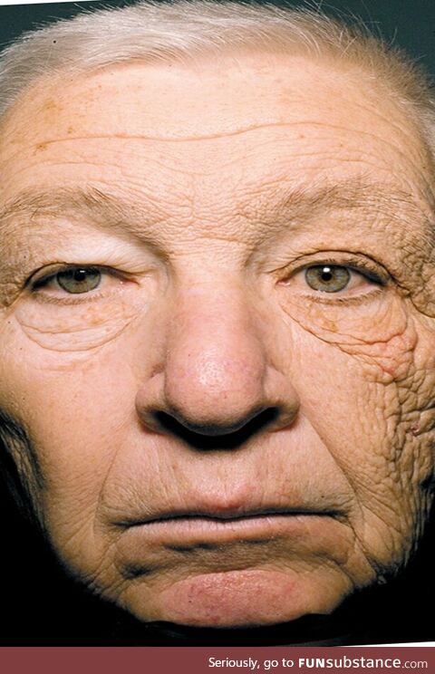 69 year old truck driver. 28 years of left sided sun exposure through the drivers side