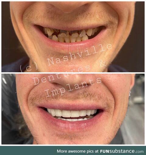 (oc) Fixed implant dentistry is life changing