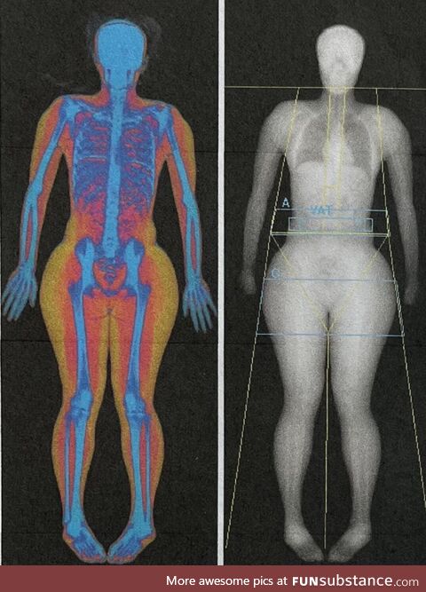 Body Composition of bone, muscle, and fat