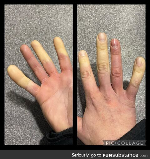 Winter = Raynaud’s Syndrome