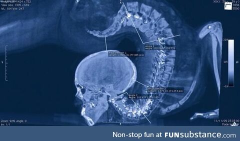 X-ray of a contortionist