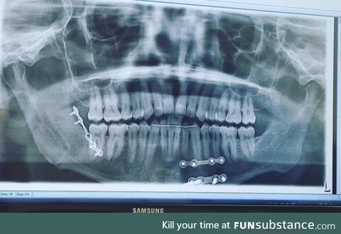 [OC] Got jumped, broke my jaw and I was wired shut. These are the screws holding it all